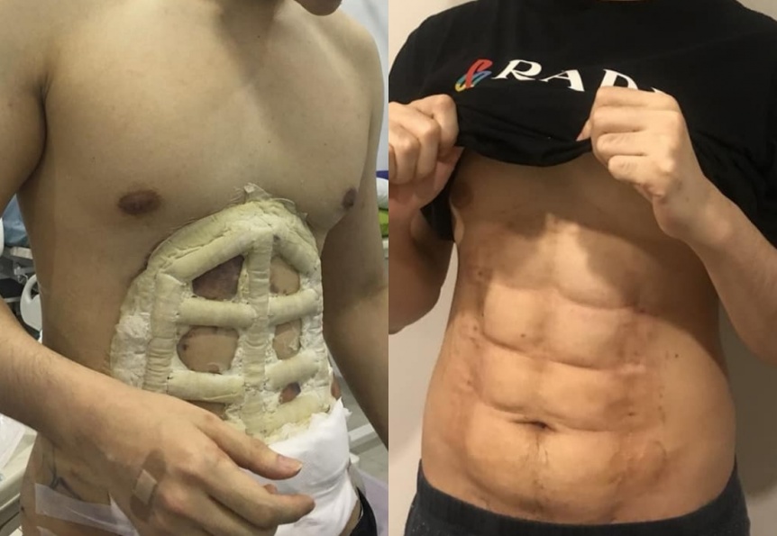 Hospital tailandés ofrece abdominales instantáneos y sin esfuerzo